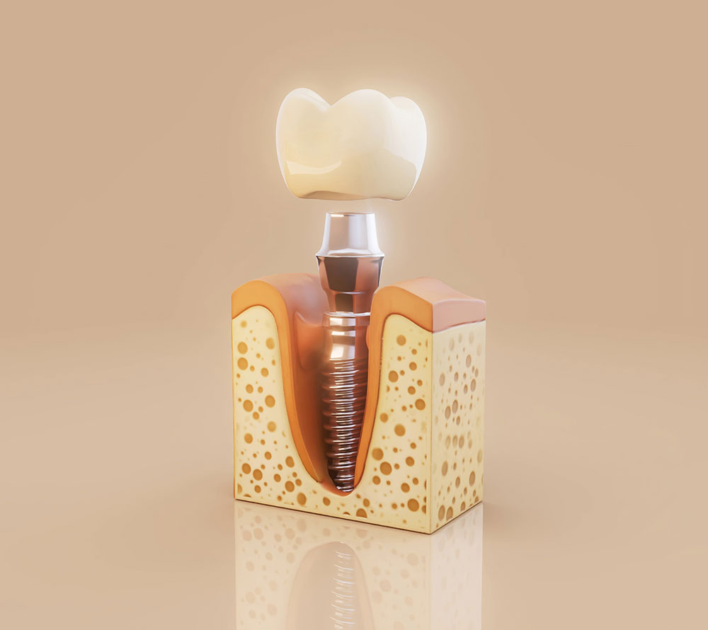 How Do Dental Implants Work?