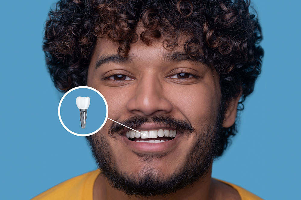 Benefits of Dental Implants