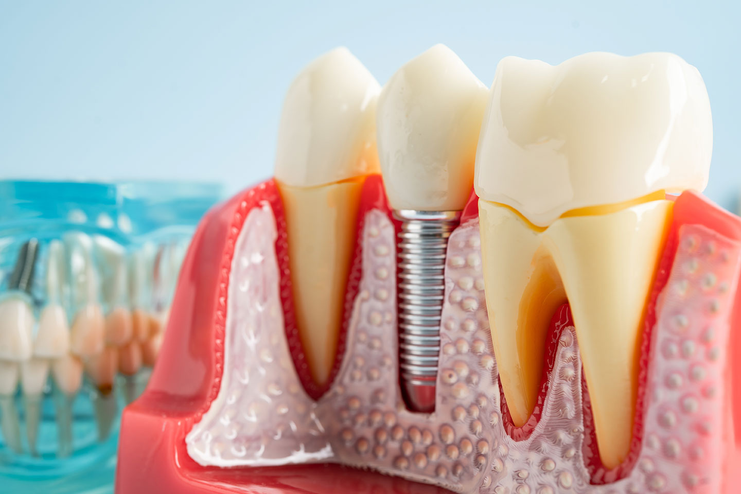 A dental implant 3D model, with an artificial tooth root in the jaw.