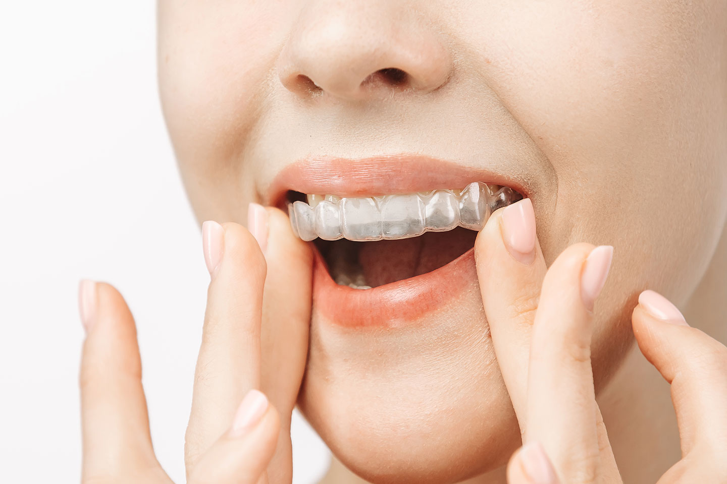 A woman uses Invisalign for their orthodontic treatment.