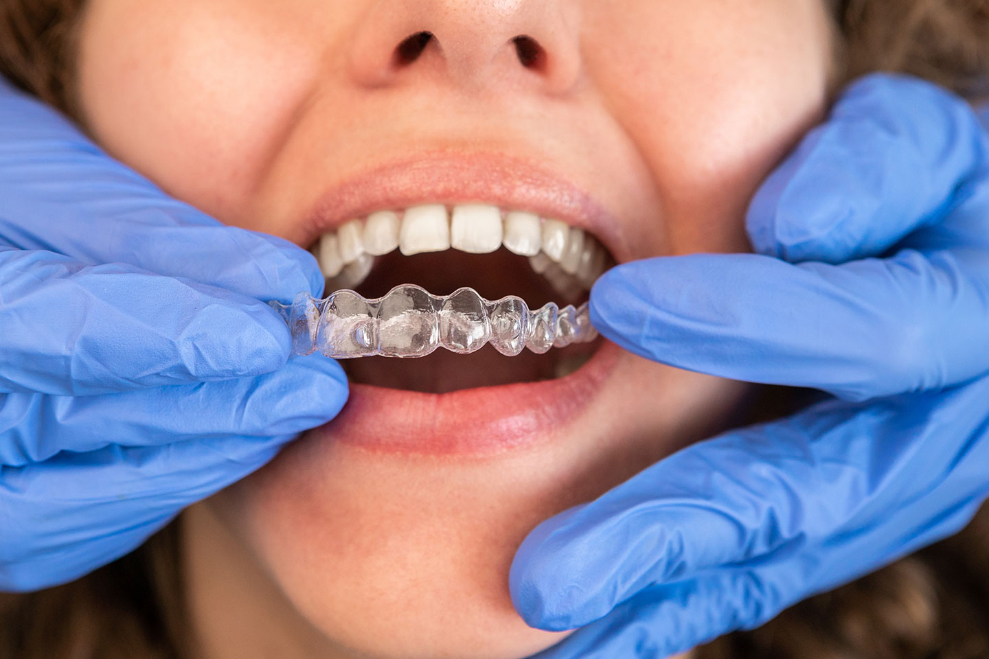 Close-up of a dentist fitting a clear orthodontic aligner onto a patient's teeth.