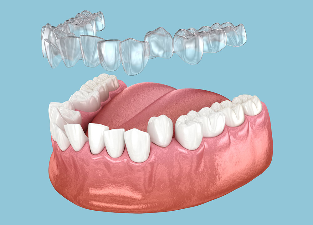 Invisalign clear aligners being applied to misaligned teeth.
